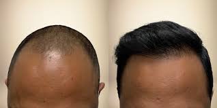 Before - Hairline Transformation